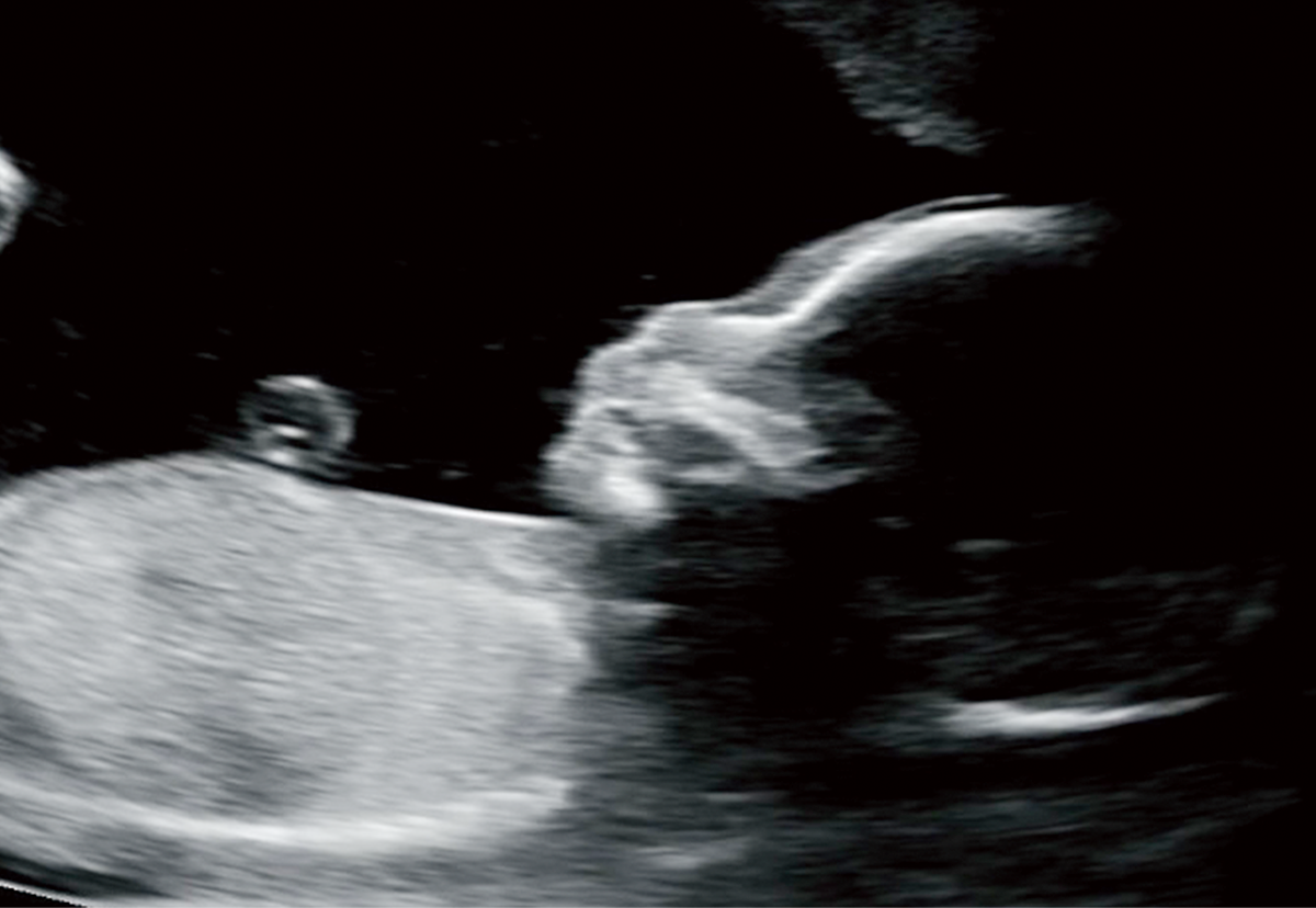 ▲B씨 부부의 첫째 아이 초음파 사진(사진 제공: B씨).